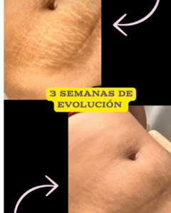 Atenuación de estrías