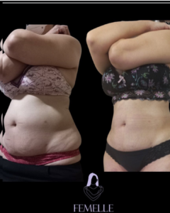 Tratamiento criomodelación